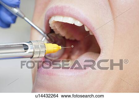 Picture - Dental anaesthesia. Fotosearch