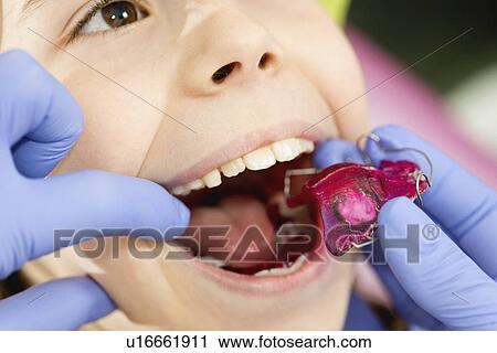 Dental braces View Large Photo Image Stock Image - Dental braces. Fotosearch