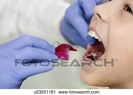 Stock Image - Dental braces. Fotosearch