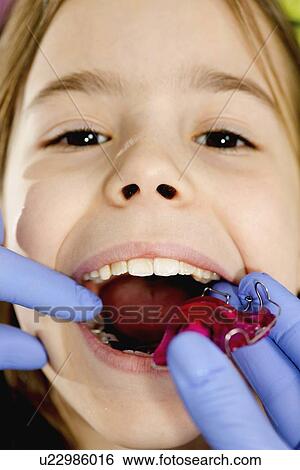 Dental braces View Large Photo Image Stock Photograph - Dental braces. Fotosearch
