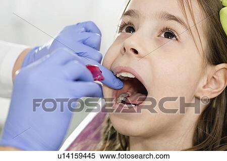 Dental braces View Large Photo Image Stock Photography - Dental braces. Fotosearch