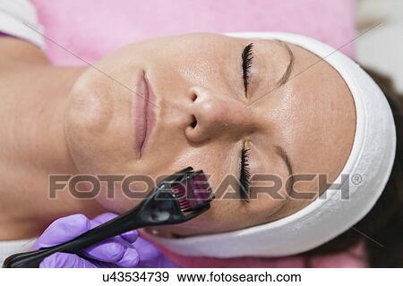 Stock Photo - Dermaroller treatment. Fotosearch