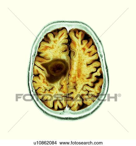 Picture - Glioblastoma brain cancer, CT scan. Fotosearch
