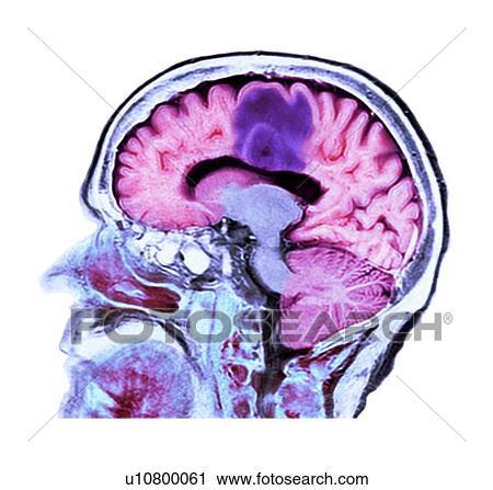 Stock Image - Glioblastoma brain cancer, CT scan. Fotosearch