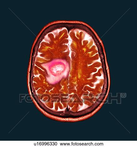 Stock Image - Glioblastoma brain cancer, CT scan. Fotosearch