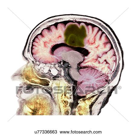 Stock Image - Glioblastoma brain cancer, CT scan. Fotosearch