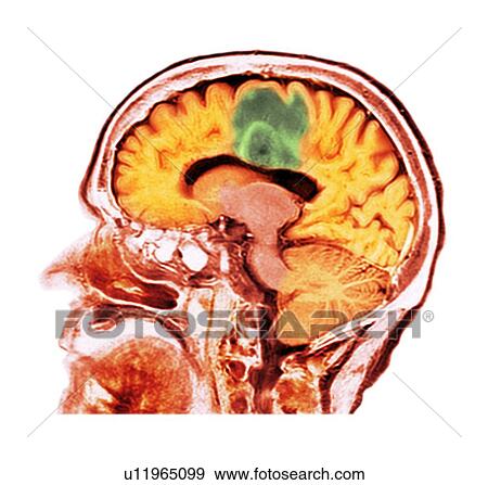 Stock Photo - Glioblastoma brain cancer, CT scan. Fotosearch