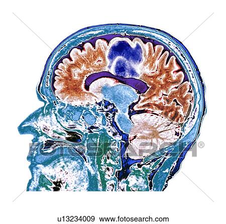 Stock Photo - Glioblastoma brain cancer, CT scan. Fotosearch