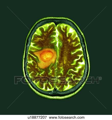 Stock Photo - Glioblastoma brain cancer, CT scan. Fotosearch