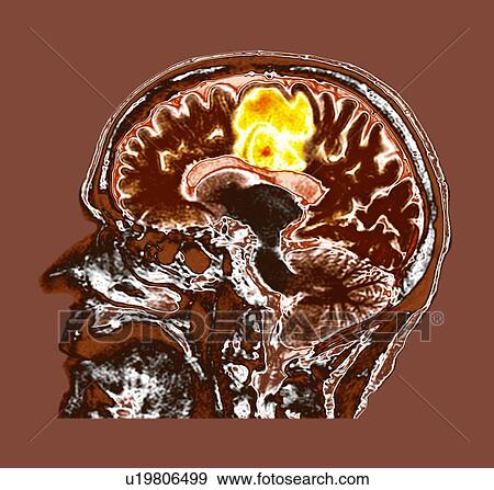 Stock Photo - Glioblastoma brain cancer, CT scan. Fotosearch