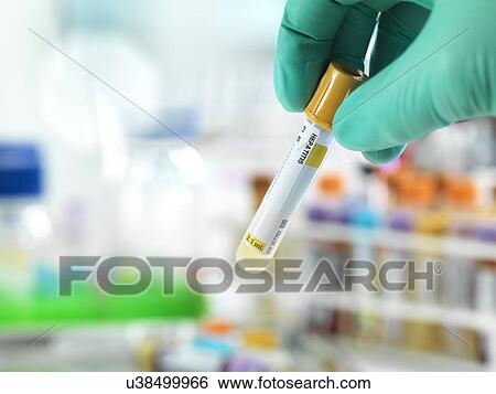 Stock Photograph - Hepatitis test. Fotosearch