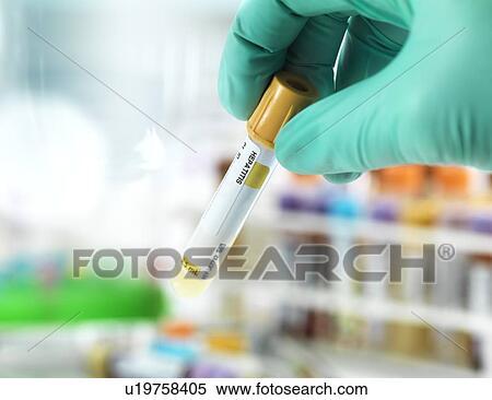 Stock Photography - Hepatitis test. Fotosearch
