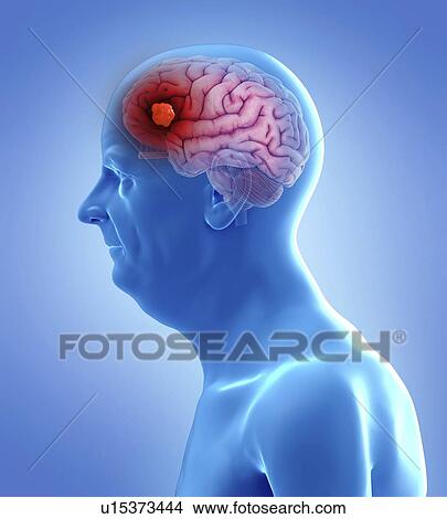 Picture - Illustration of a brain tumor. Fotosearch
