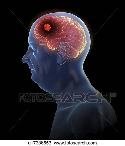 Illustration of a brain tumor View Large Photo Image Stock Image - Illustration of a brain tumor. Fotosearch