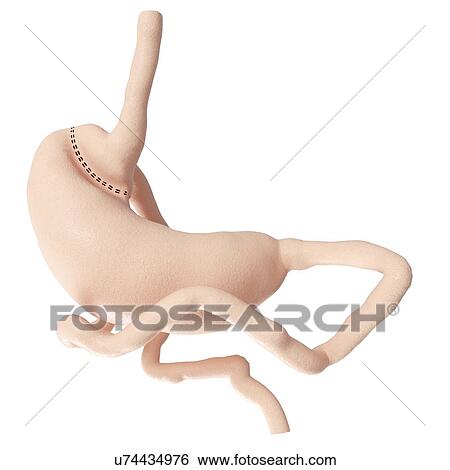 Illustration of a gastric bypass View Large Photo Image Stock Photograph - Illustration of a gastric bypass. Fotosearch