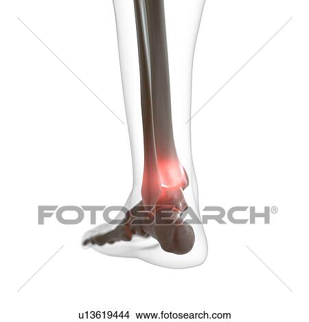 Illustration of a painful ankle View Large Photo Image Picture - Illustration of a painful ankle. Fotosearch