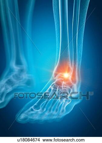 Illustration of a painful ankle View Large Photo Image Picture - Illustration of a painful ankle. Fotosearch