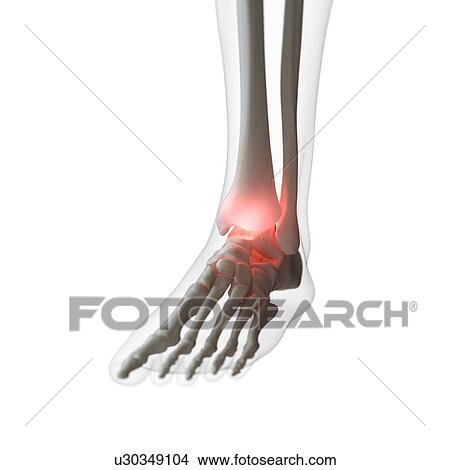Illustration of a painful ankle View Large Photo Image Picture - Illustration of a painful ankle. Fotosearch