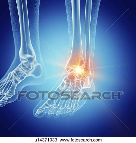 Stock Image - Illustration of a painful ankle. Fotosearch