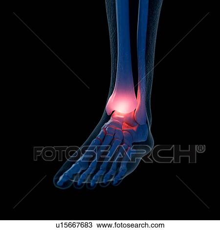 Illustration of a painful ankle View Large Photo Image Stock Image - Illustration of a painful ankle. Fotosearch