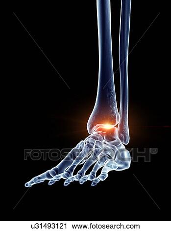 Stock Image - Illustration of a painful ankle. Fotosearch
