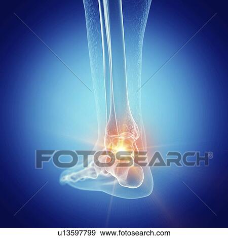 Stock Photo - Illustration of a painful ankle. Fotosearch