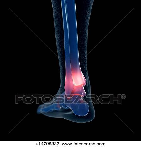 Illustration of a painful ankle View Large Photo Image Stock Photo - Illustration of a painful ankle. Fotosearch