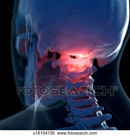 Illustration of a painful atlas bone View Large Photo Image Stock Image - Illustration of a painful atlas bone. Fotosearch
