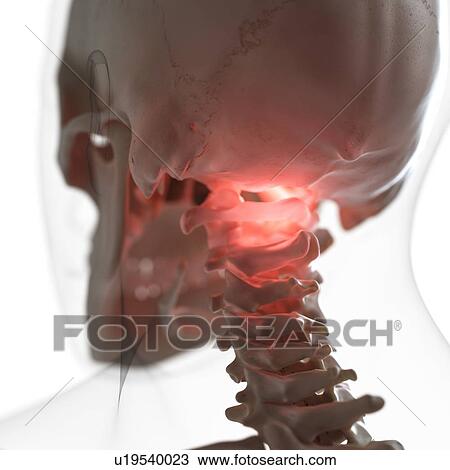 Illustration of a painful atlas bone View Large Photo Image Stock Image - Illustration of a painful atlas bone. Fotosearch
