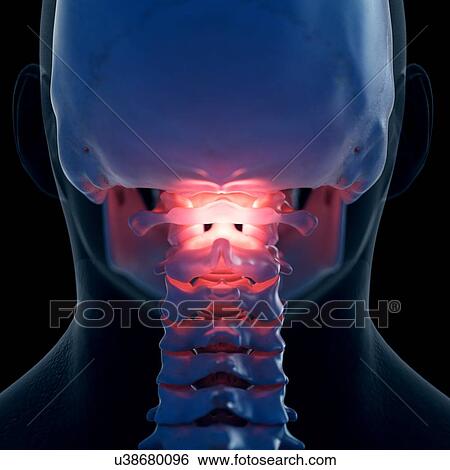 Stock Photograph - Illustration of a painful atlas bone. Fotosearch