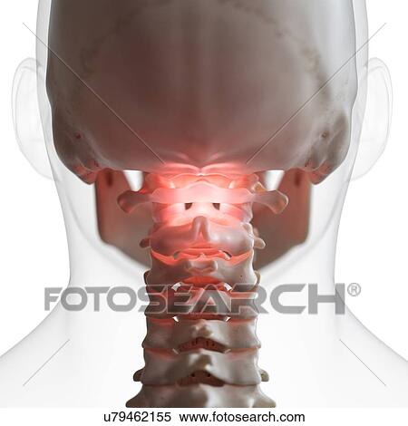 Stock Photography - Illustration of a painful atlas bone. Fotosearch