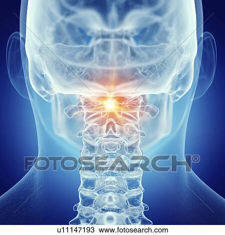 Stock Image - Illustration of a painful atlas. Fotosearch
