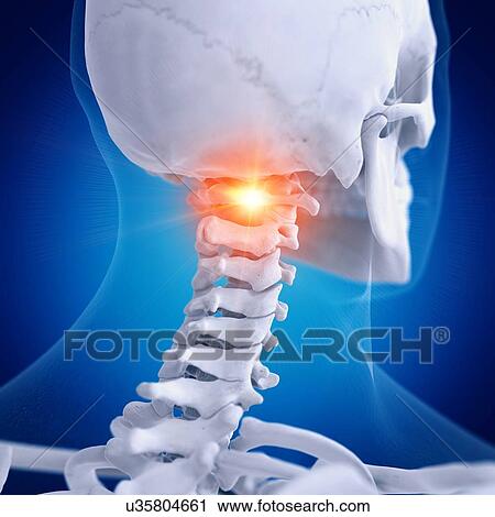 Stock Image - Illustration of a painful atlas vertebrae. Fotosearch