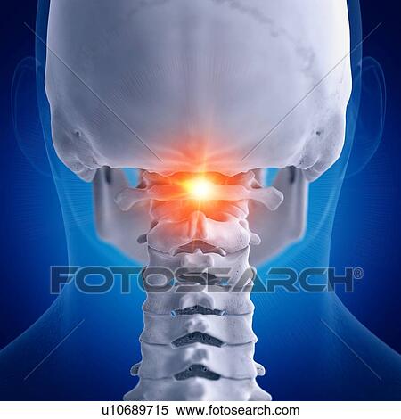 Illustration of a painful atlas vertebrae View Large Photo Image Stock Photography - Illustration of a painful atlas vertebrae. Fotosearch