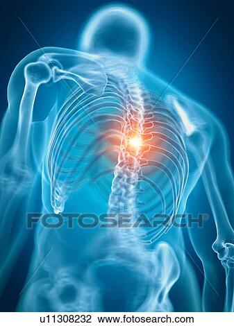 Illustration of a painful back View Large Photo Image Stock Image - Illustration of a painful back. Fotosearch
