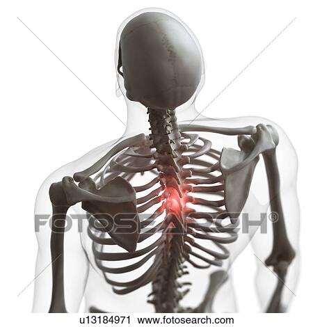 Stock Image - Illustration of a painful back. Fotosearch