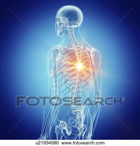 Stock Image - Illustration of a painful back. Fotosearch
