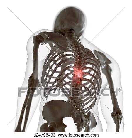 Stock Image - Illustration of a painful back. Fotosearch