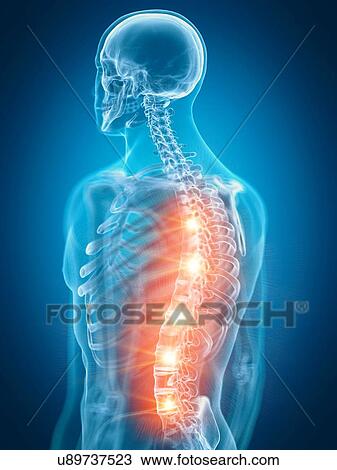 Illustration of a painful back View Large Photo Image Stock Image - Illustration of a painful back. Fotosearch