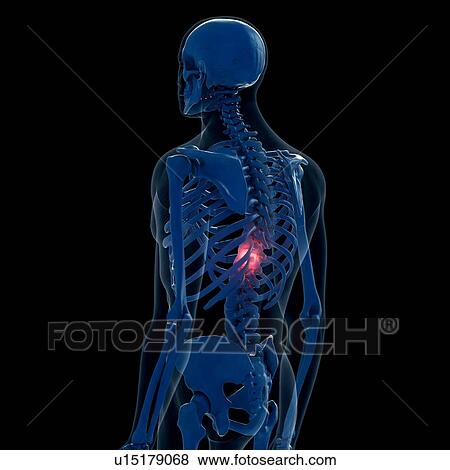 Stock Photo - Illustration of a painful back. Fotosearch
