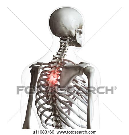 Stock Photograph - Illustration of a painful back. Fotosearch