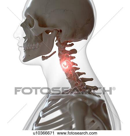 Illustration of a painful cervical spine View Large Photo Image Stock Image - Illustration of a painful cervical spine. Fotosearch