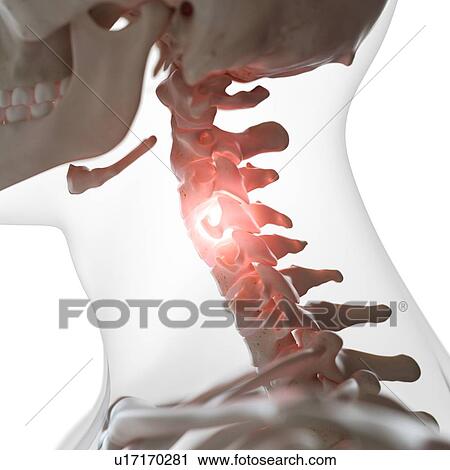 Stock Image - Illustration of a painful cervical spine. Fotosearch