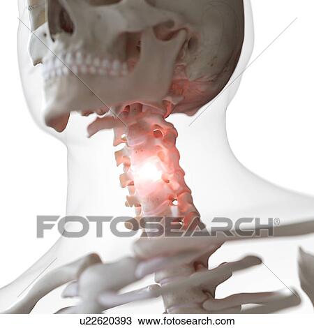 Stock Image - Illustration of a painful cervical spine. Fotosearch