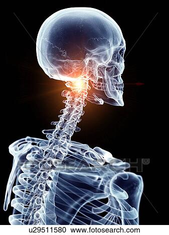 Illustration of a painful cervical spine View Large Photo Image Stock Image - Illustration of a painful cervical spine. Fotosearch