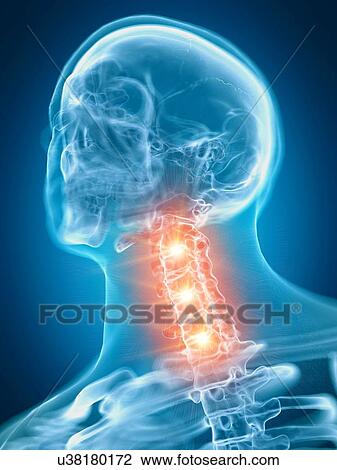 Stock Image - Illustration of a painful cervical spine. Fotosearch