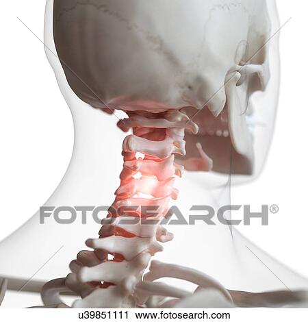 Illustration of a painful cervical spine View Large Photo Image Stock Image - Illustration of a painful cervical spine. Fotosearch