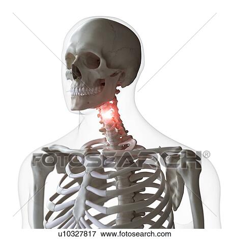 Stock Photo - Illustration of a painful cervical spine. Fotosearch