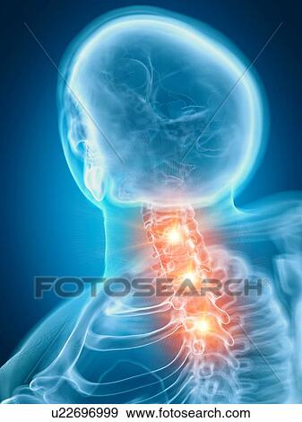 Stock Photo - Illustration of a painful cervical spine. Fotosearch