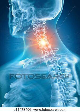 Illustration of a painful cervical spine View Large Photo Image Stock Photograph - Illustration of a painful cervical spine. Fotosearch